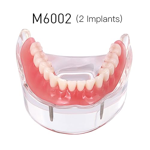 Miniatura 2 de Dientes dentales Modelo Typodont Restauración de implantes M6002 Sobredentadura 2 Implantes Inferior Inferior Demo para Estudio Enseñar