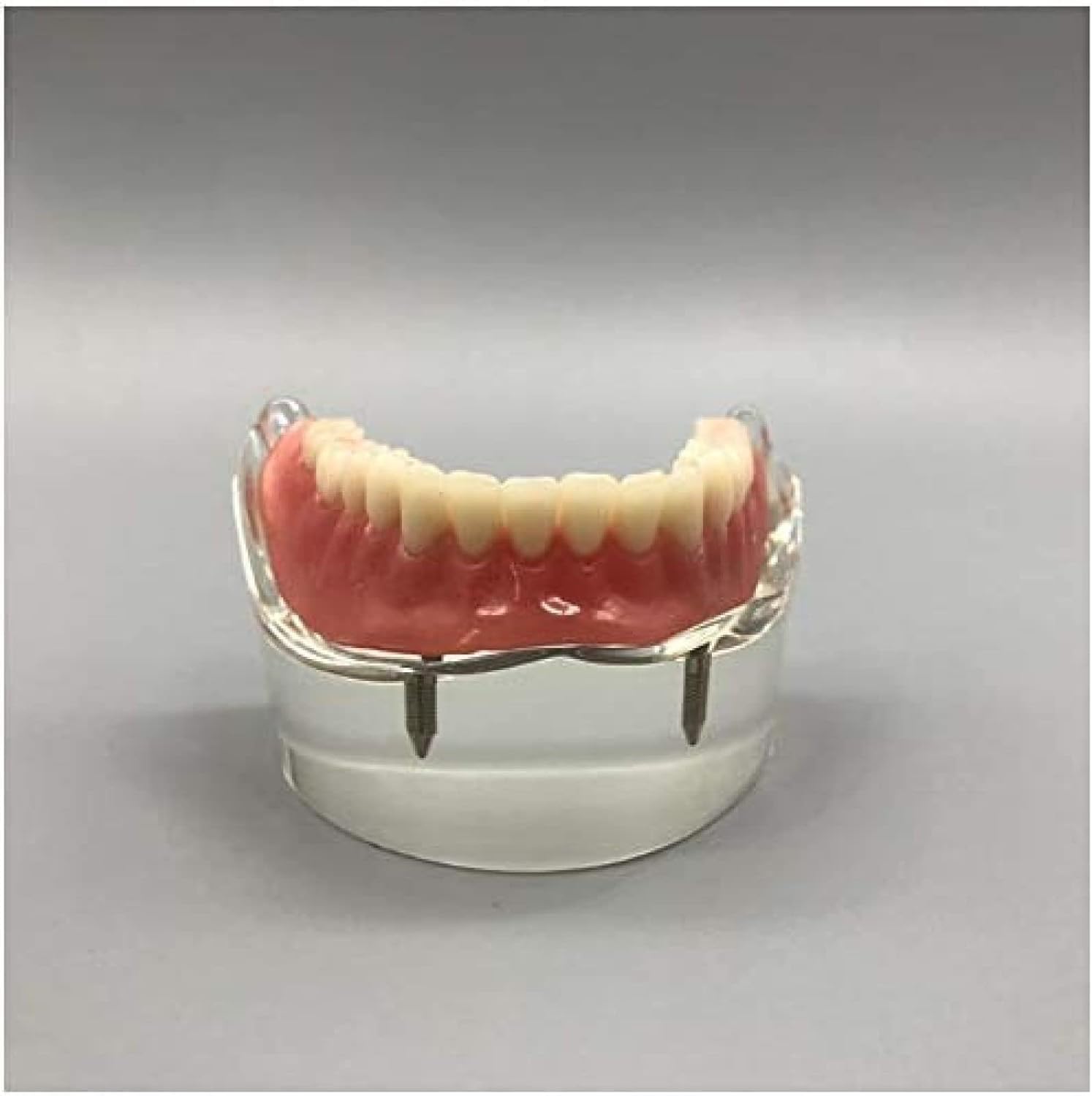 Modello Dentale - Impianto Dentale - Overdenture Inferiore Mandibolare 2 Impianti Demo Per L'insegnamento E Lo Studio