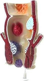Rectum Model - Rectum Pathological Model - Anatomical Human Disease Rectum Ulceration Acne Pathological Model - Human Digestive systemuseful SaiFei