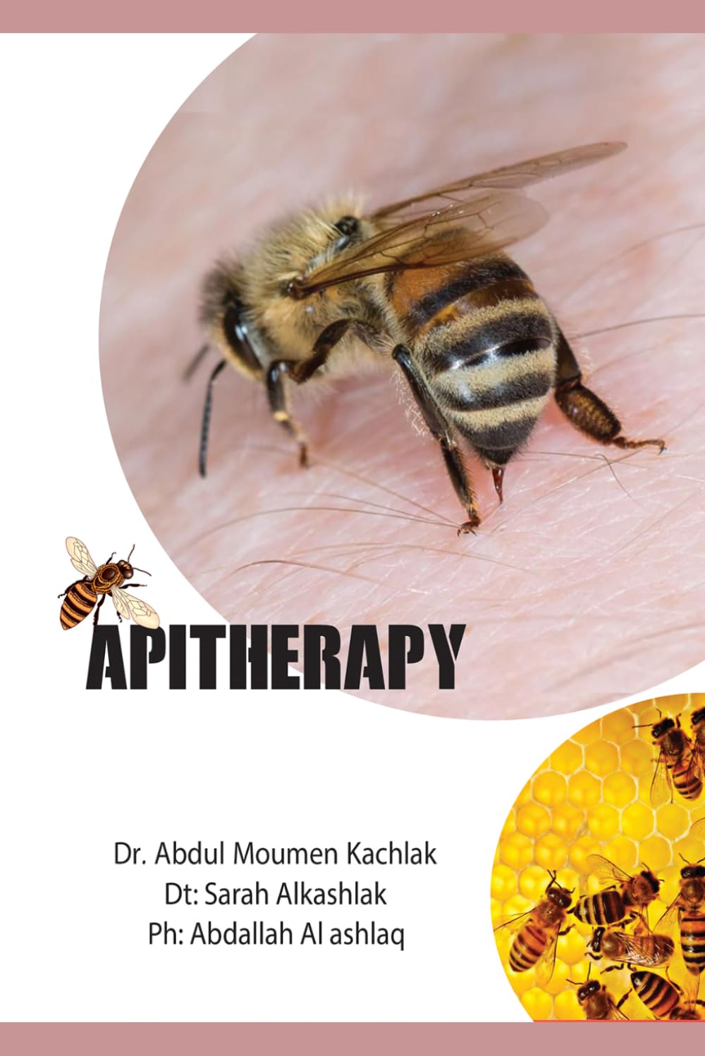 Treatment with Bee Venom and Honey: (Apitherapy)