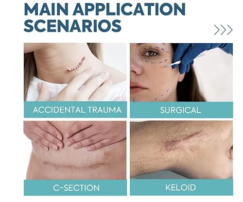 Miniatura 3 de Hojas de silicona para cicatrices de 1.6 x 120 pulgadas, grado médico, de larga duración, rollo de cinta reutilizable para cesárea, cicatrices