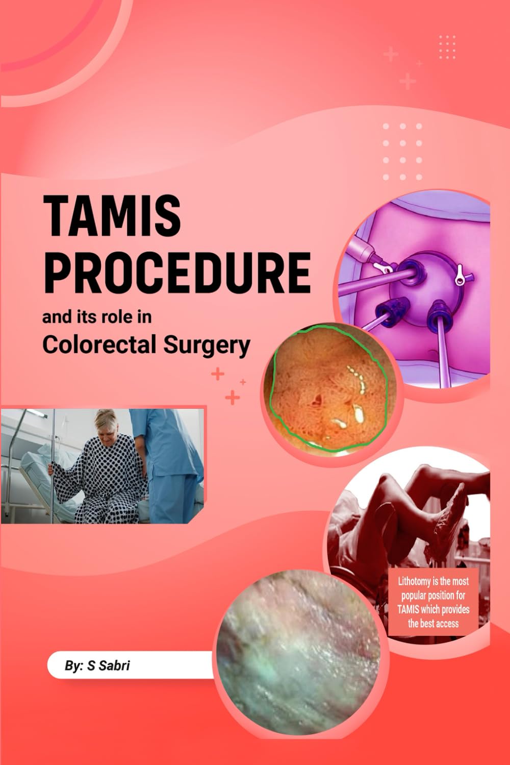 TAMIS PROCEDURE and its role in COLORECTAL SURGERY