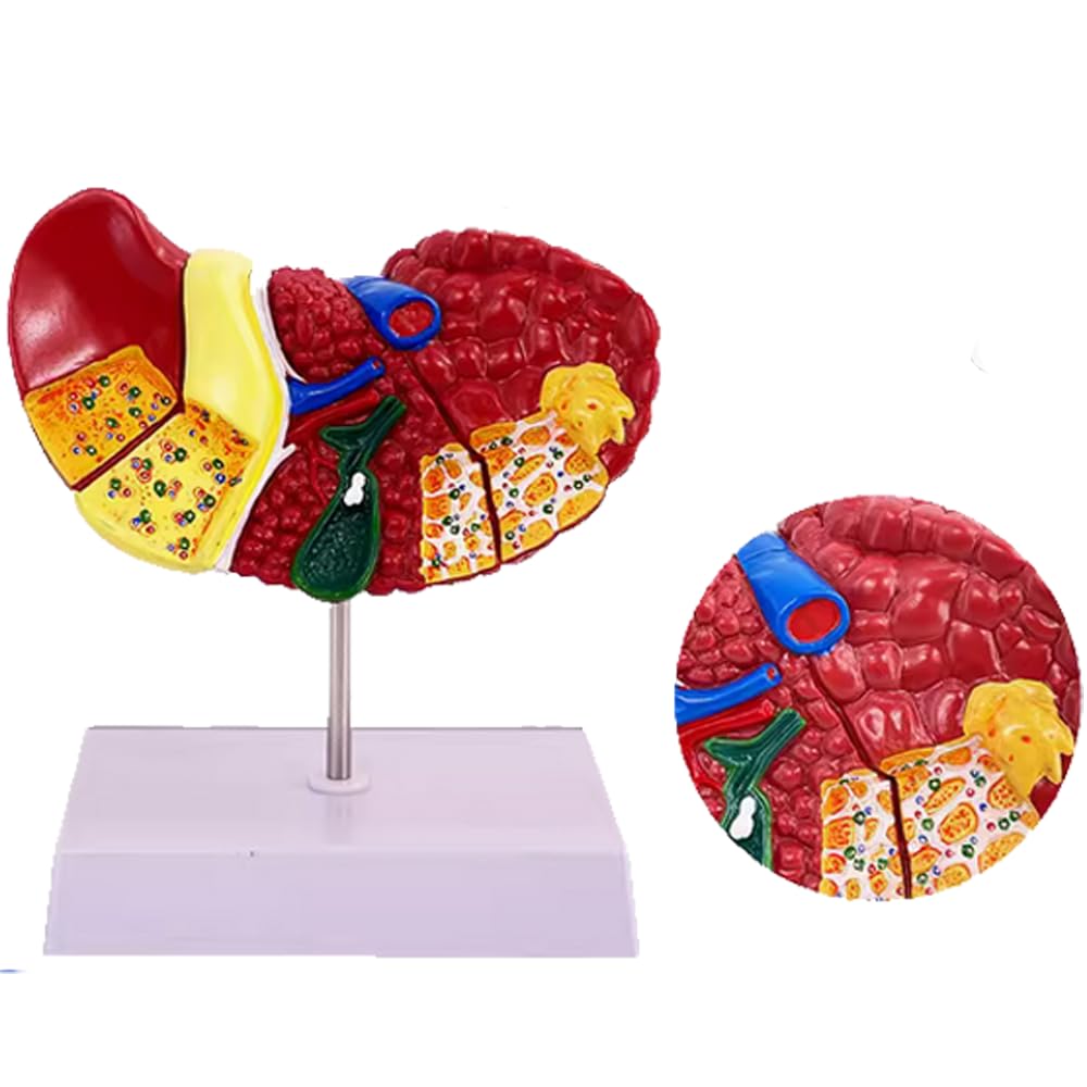 Medical Science Colored Pathology Liver Anatomical Model
