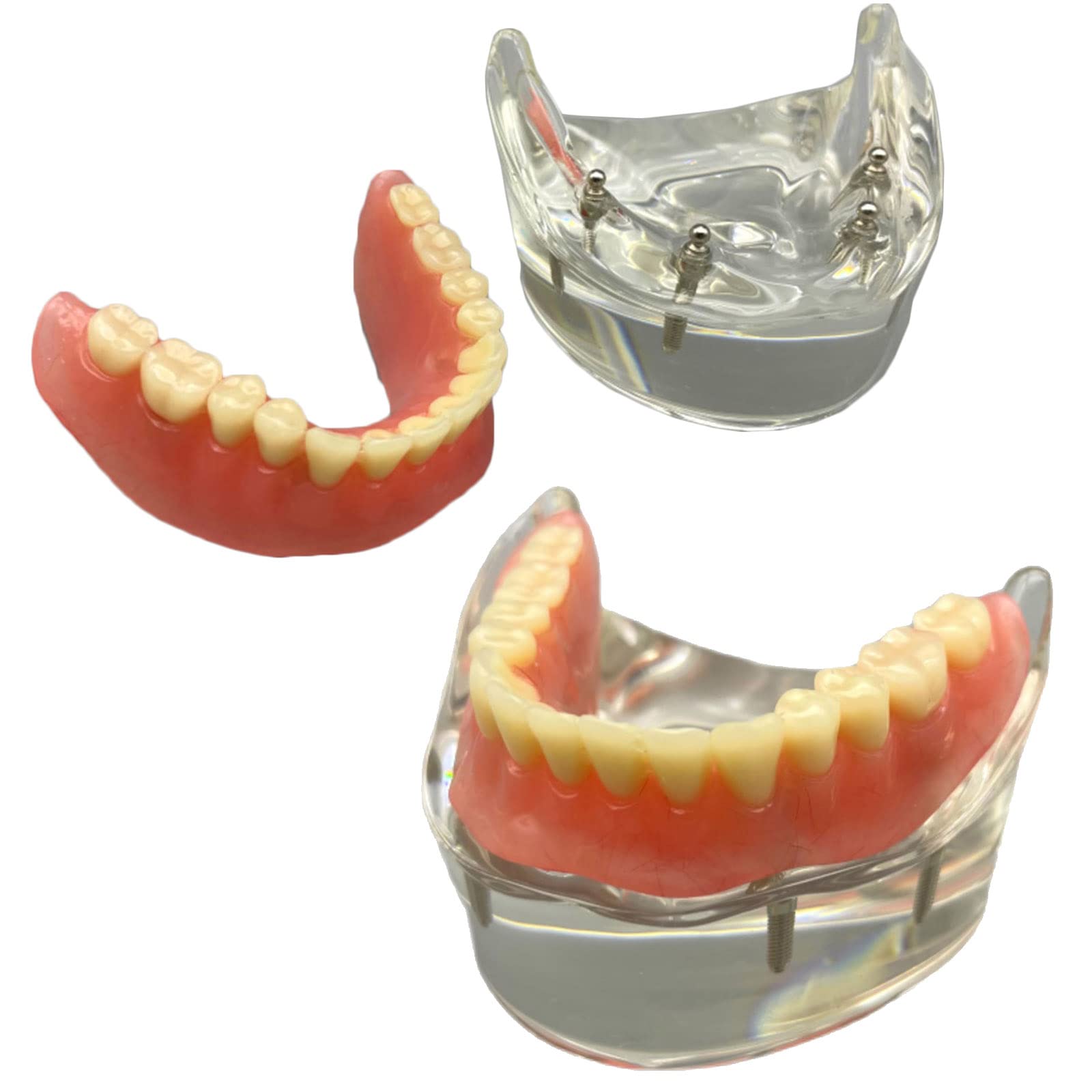 Zahnimplantat Modell - Overdenture 4 Implantate Modell - Transparentes Demo Dental Zahnmodell für Studie Erwachsene Standard Lehrmodell (Untere Zähne)