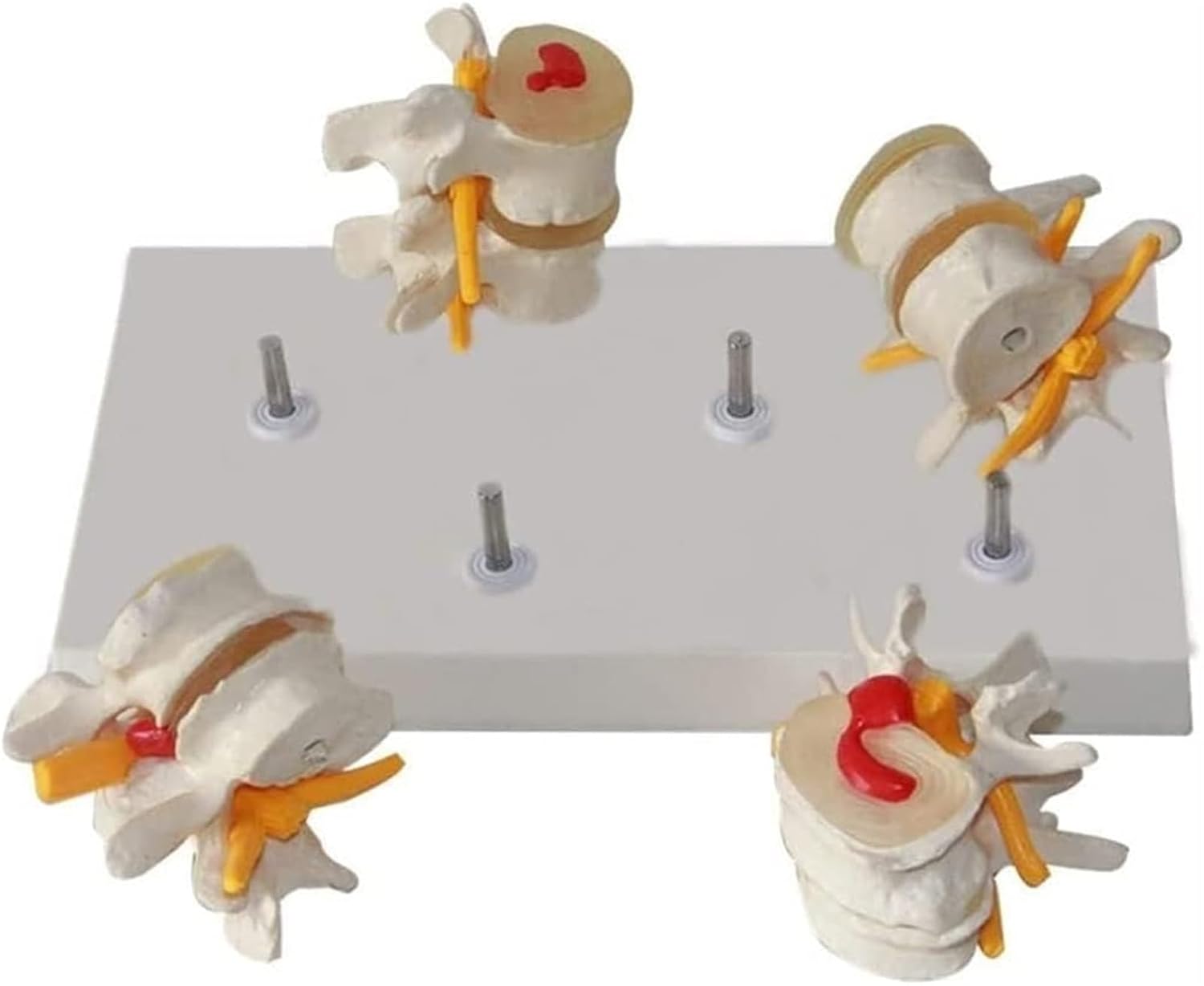 Anatomy Model, Pathological Lumbar Spine, Degenerative Intervertebral Disc Disease Model, Teaching Aids
