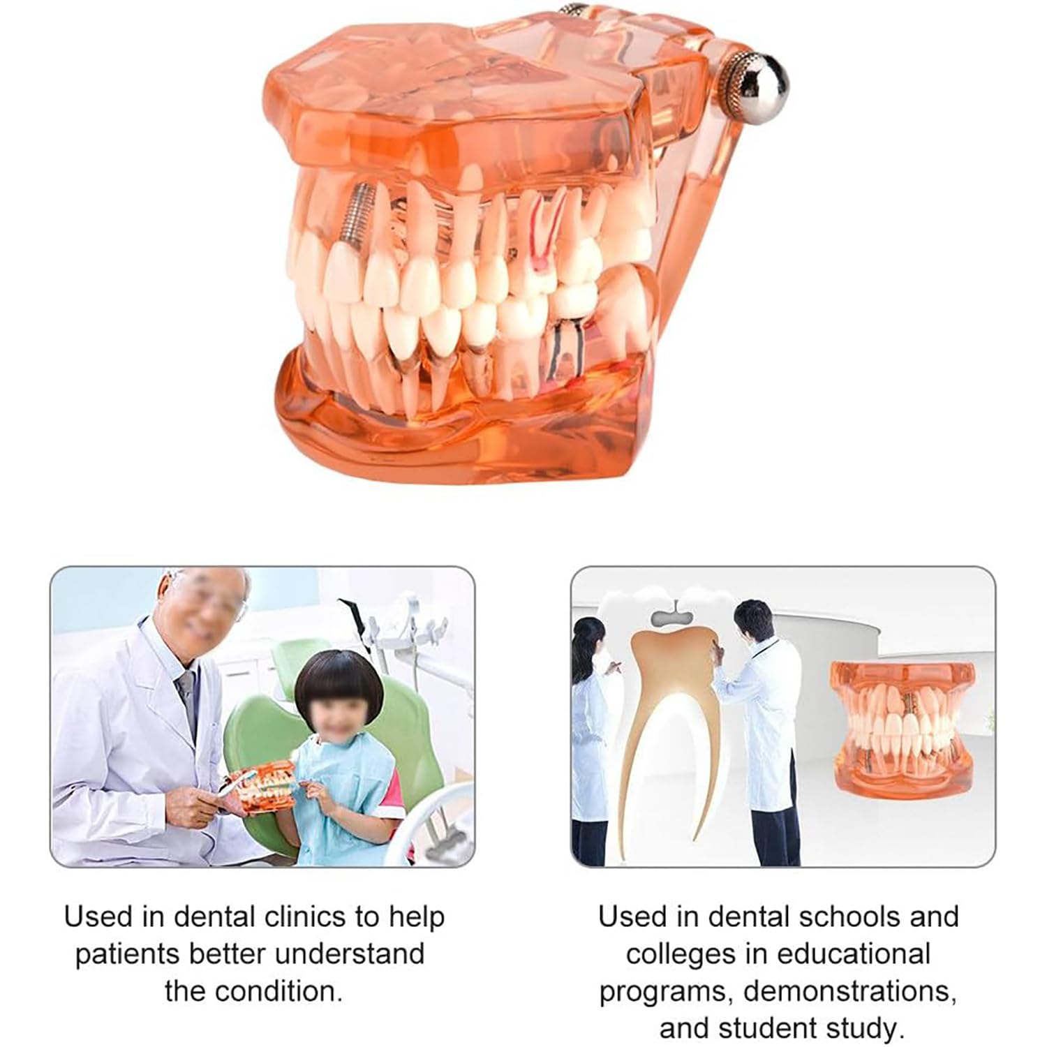 Pomarańczowy zdejmowany model zębów dentystycznych, model dentystyczny, nauczanie chorób zębów, model zębów implantologicznych, do komunikacji lekarz-pacjent