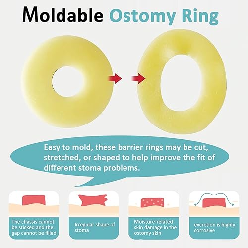 Miniatura 2 de 20 anillos de barrera para ostomía, suministros de ostomía hidrocoloide médica, anillo de ostomía moldeable, anillos extensores de piel sin fugas,