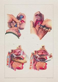 Anatomy POLYP NASAL CAVITY print SRA3 12x18 conqueror laid paper