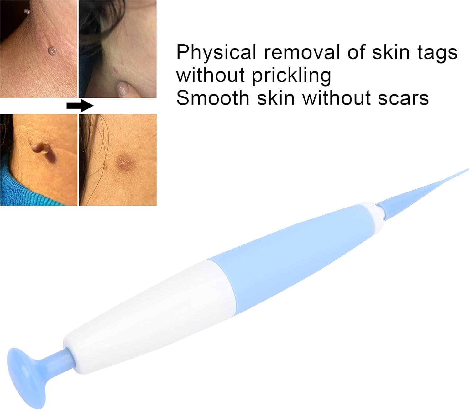 Fibroma Removal Device, Skin Tag Removal Kit Tool for removing fleshy