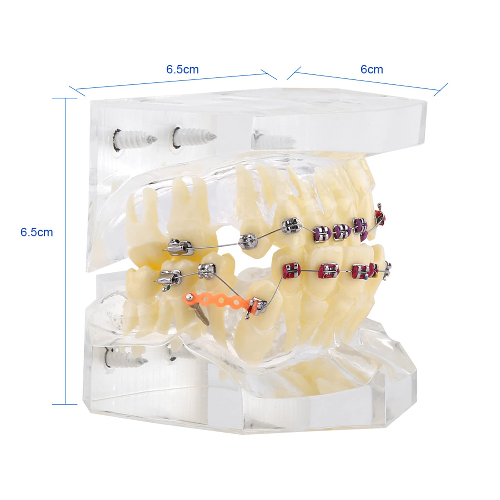 Staffe Ortodontiche, Modello di Denti Trattamento Ortodontico Dentale Studio di Malocclusione Modello di Denti con Staffe Dentali a Catena Metallica