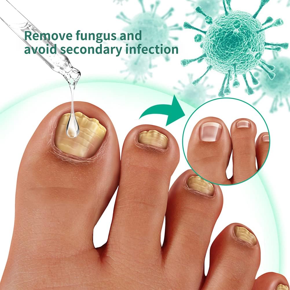 KLEOAD Toenail Fungus Treatment Oil, Healthy Skin, Nail Fungus Removal Liquid Natural Toenail Fungus Oil Nail Care Nail Treatment, May Support Strong Healthy Natural Nails, Healthy Skin : Health & Household