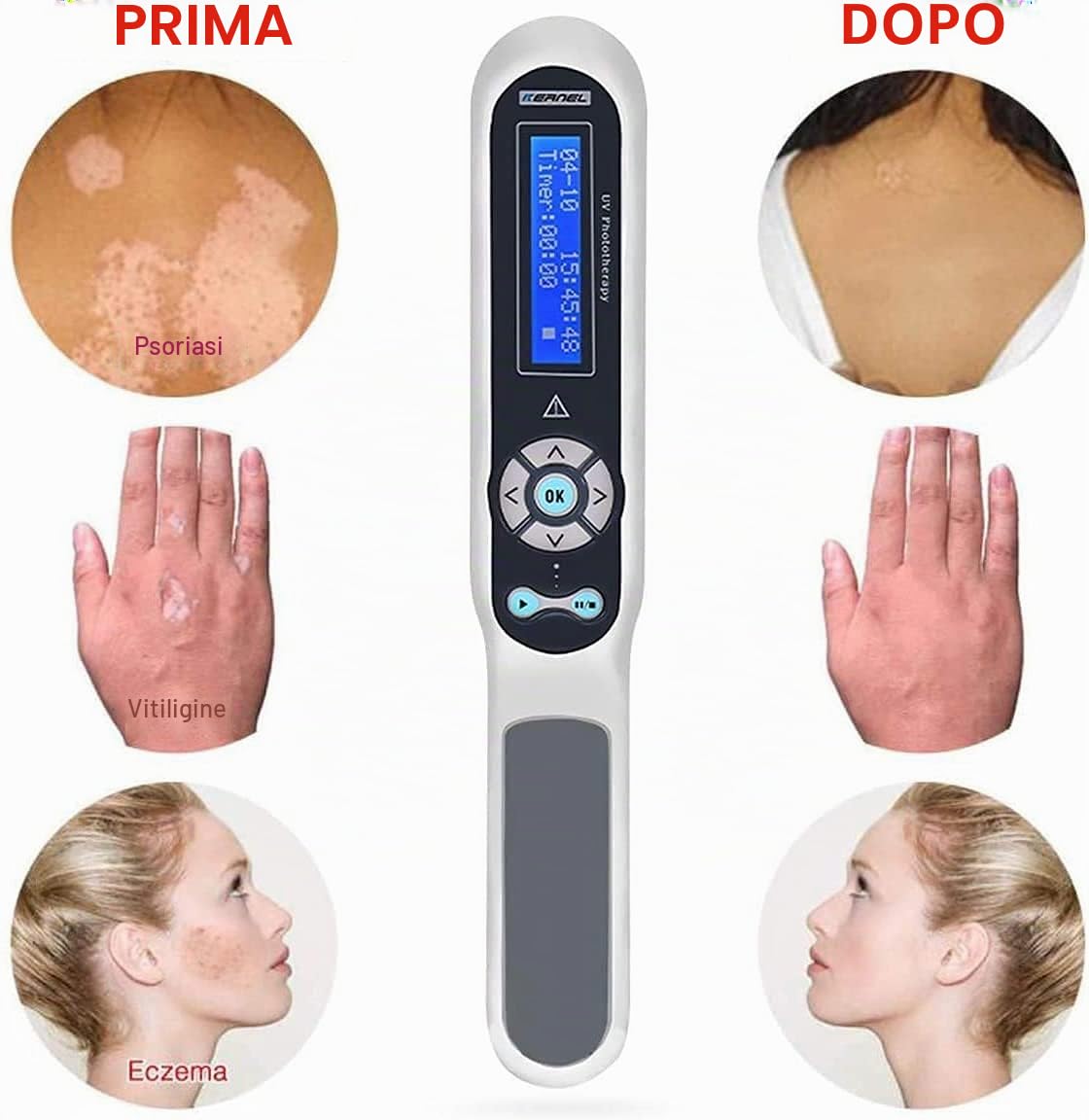 HASMI, lampada UV a banda stretta 311 nm per fototerapia, con pettine incluso, occhiali protettivi inclusi, controllo LCD digitale del timer di terapia