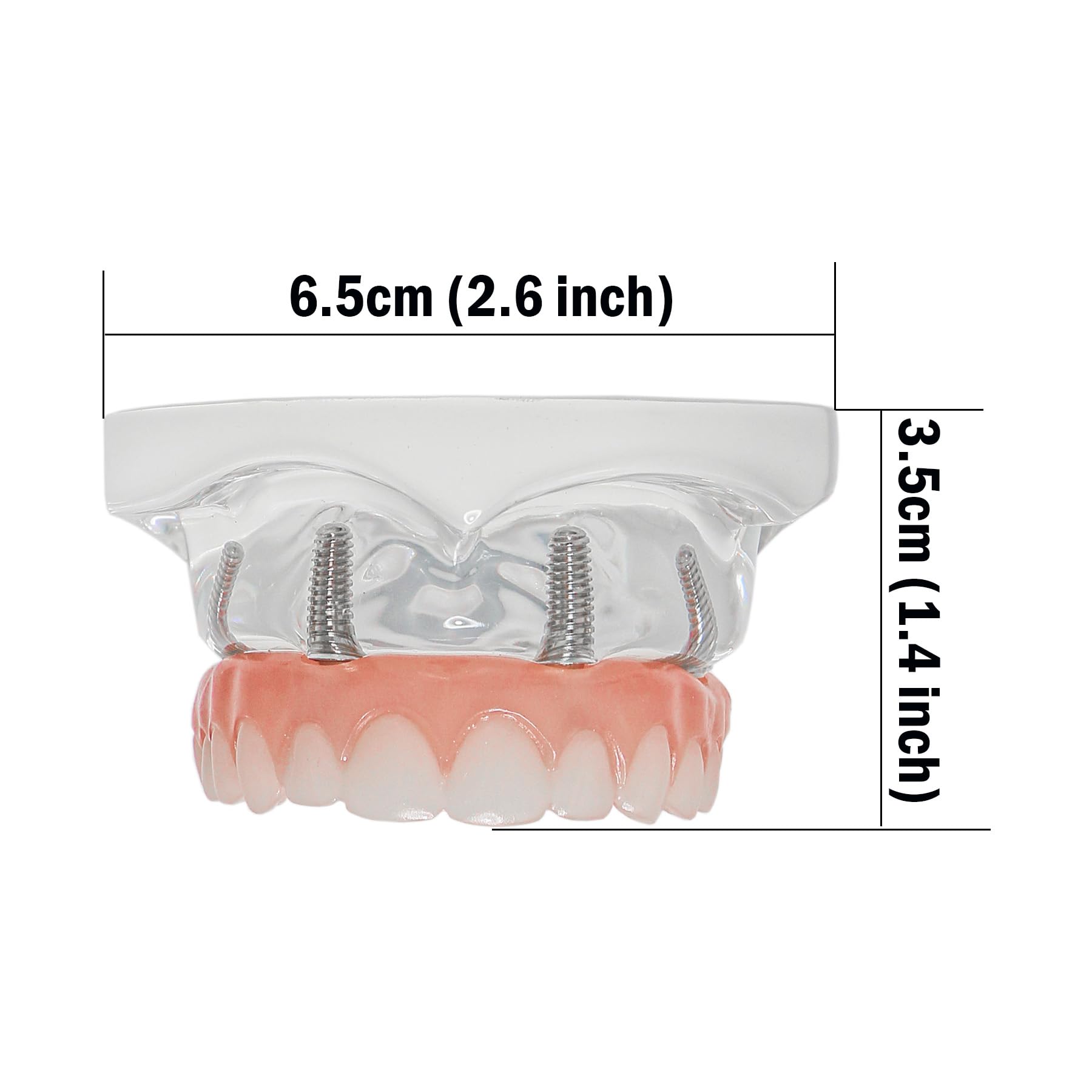 Dental Implant Upper Jaw All-on-4 Treatment Model, Detachable Overdenture
