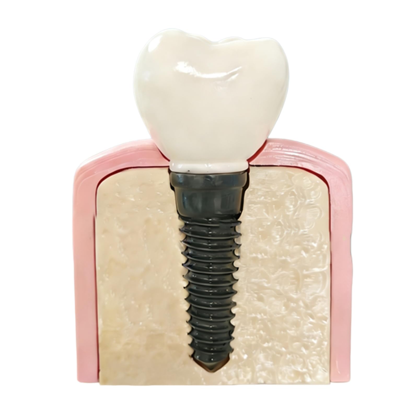 Modello di Dente in Resina per Clinica Ortodontica, Decorazione da Scrivania per Studio Dentistico o Regalo per Ortodontista