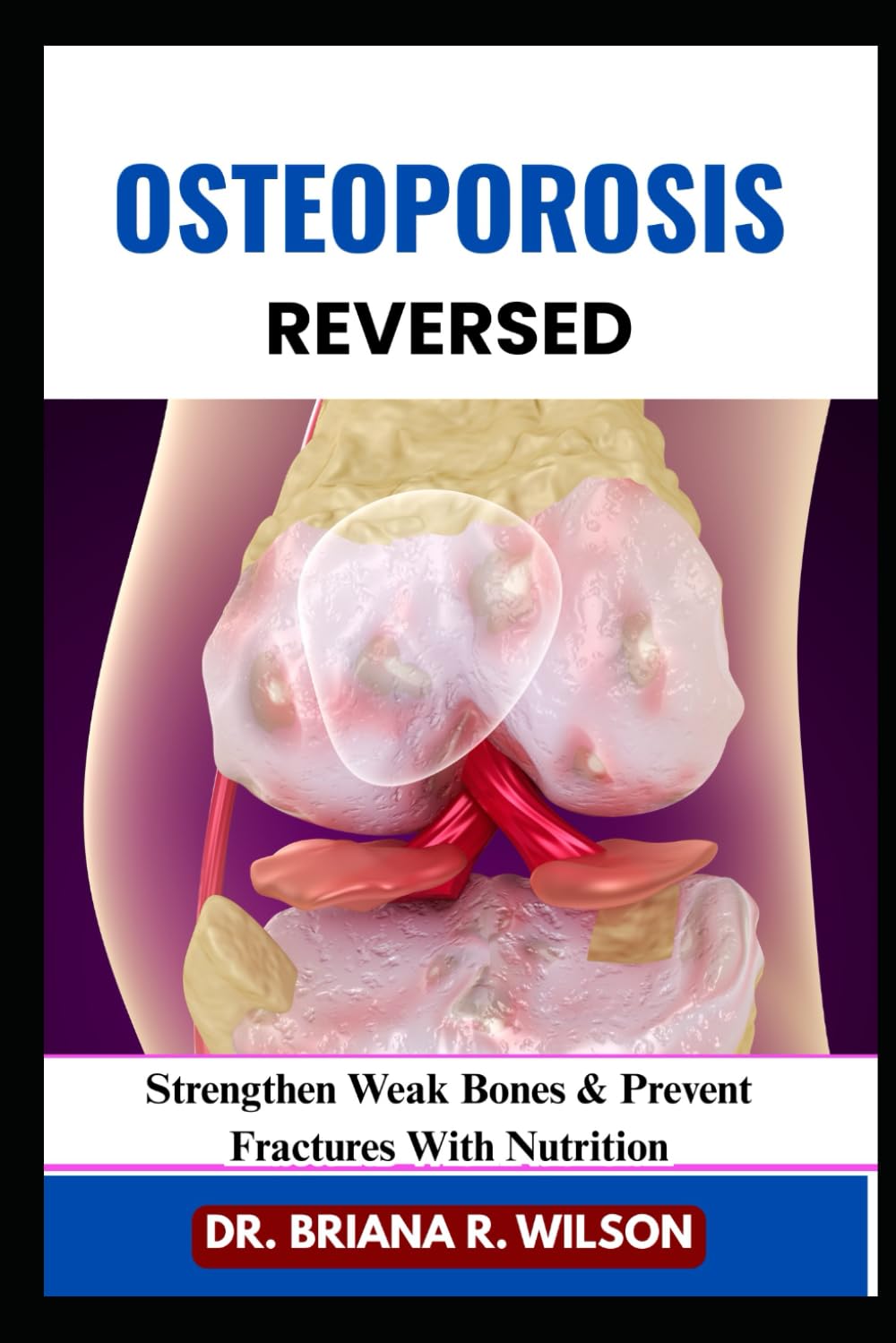 OSTEOPOROSIS REVERSED: Strengthen Weak Bones & Prevent Fractures With Nutrition