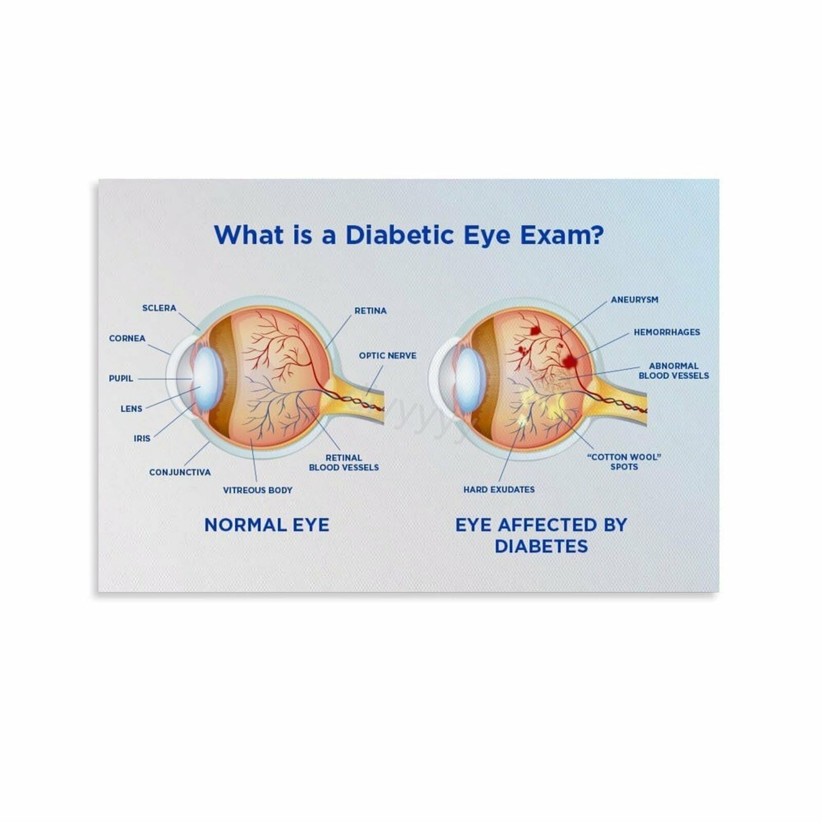 QMKADFQXF Ophthalmology Chart Diabetic Retinopathy Reference Diabetes Eye Disease Educational Poster for Clinic Classroom Decor(Framed,12x18inch(30x45cm))