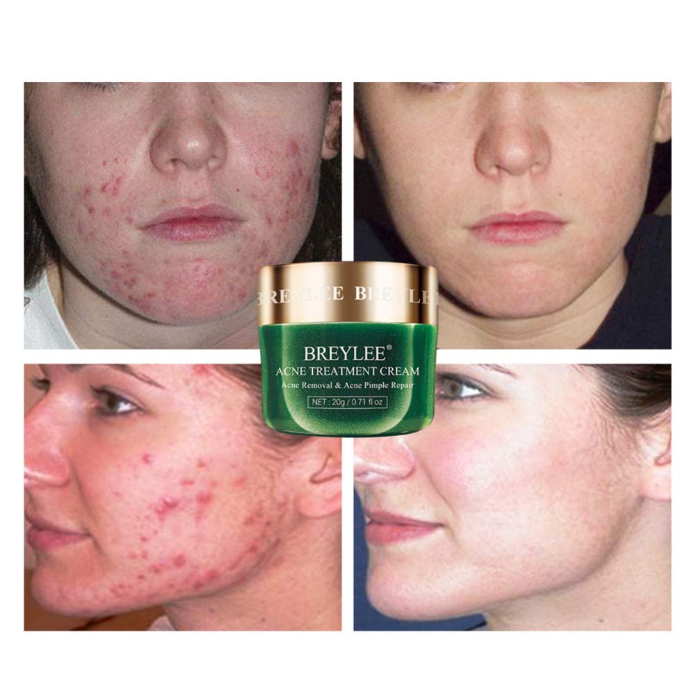 Reparación del acné cicatrices Crema antiacné facial Crema antiacné Crema antiacné Pimple Oil Control Reencoger los poros Sérum Hidratante para la cara