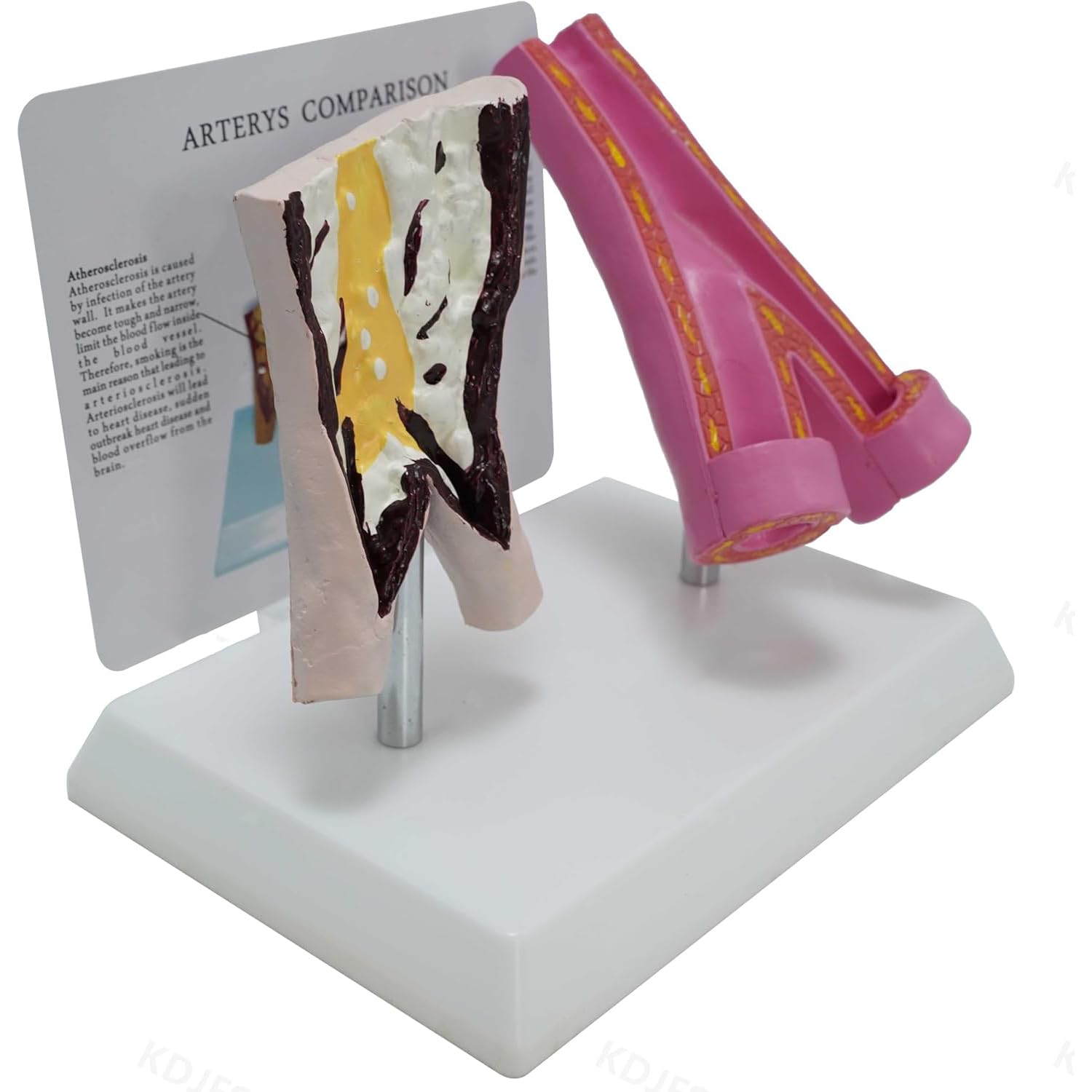 WHOOLEFUN Human Arterial Pathological Model, Smoker Blood Vessels and Healthy Blood Vessels Comparative Model, Atherosclerosis Teaching Display Tool, for Students, Doctors, Researchers