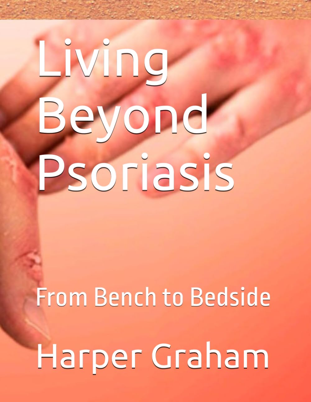 Living Beyond Psoriasis: From Bench to Bedside