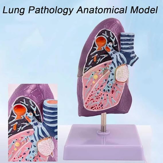 YANHAO Lung Cancer Model Pathology Lung Model 3D Human Lung Anatomical Model wirh Clear Texture & Accurate Anatomy Structure for Teaching Models Doctor-Patient Communication