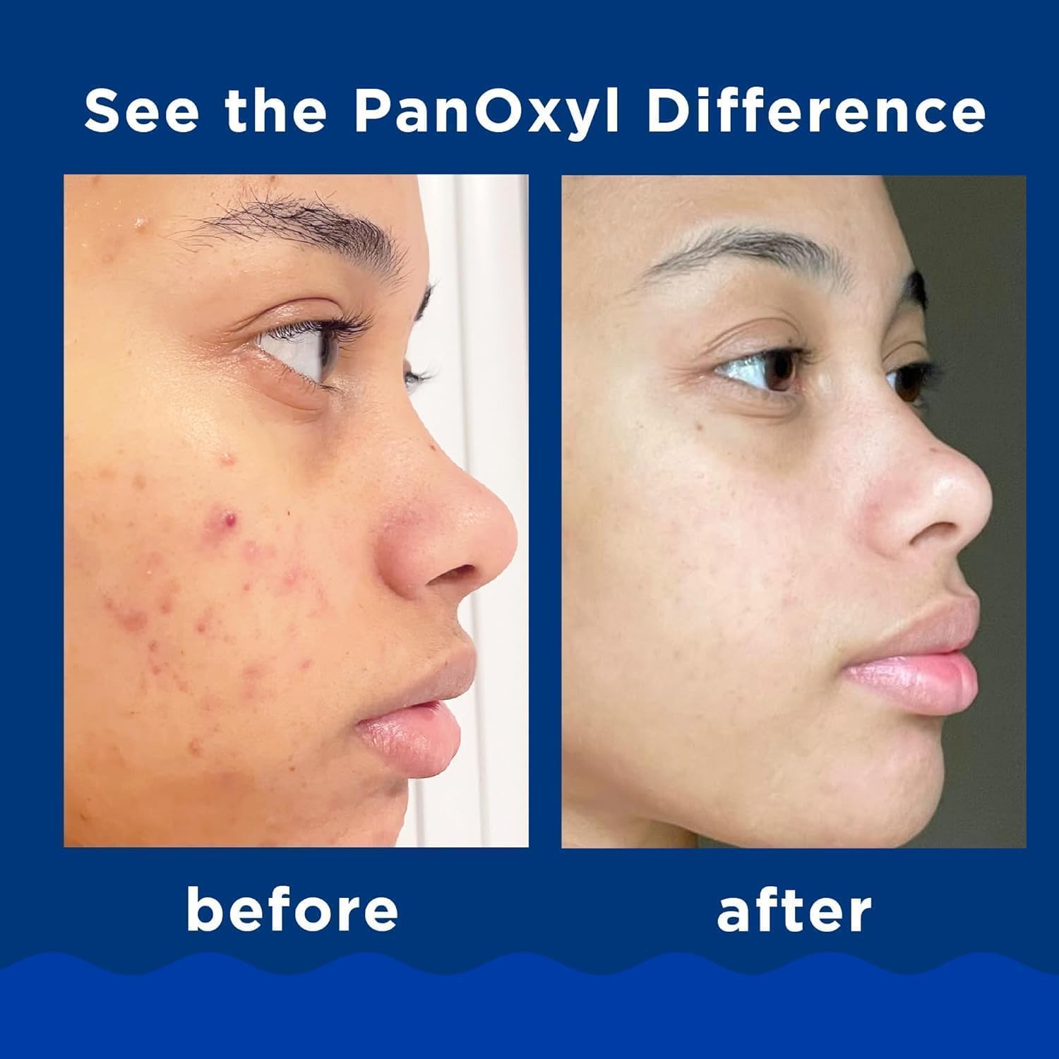 Acne Foaming Wash, lavaggio in schiuma per acne, detergente per viso delicato, per pulizia profonda dei pori, olio per pori, protezione solare minerale, per acne e tutte le tonalità della pelle, 1