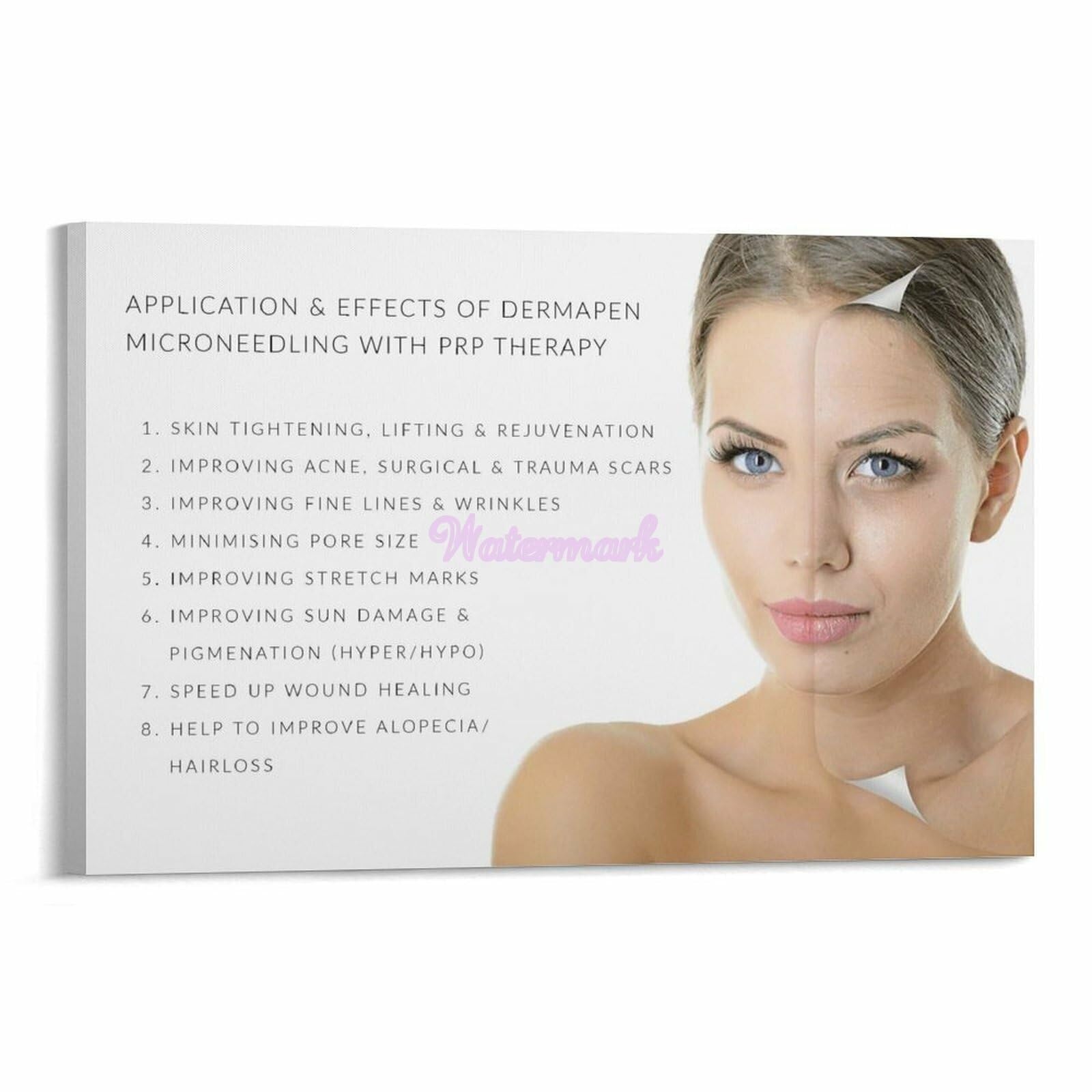 MDBJTCYZN Advanced Skincare Techniques Poster Microneedling Process Explained Chart Canvas Decor(Unframed,12x18inch(30x45cm))