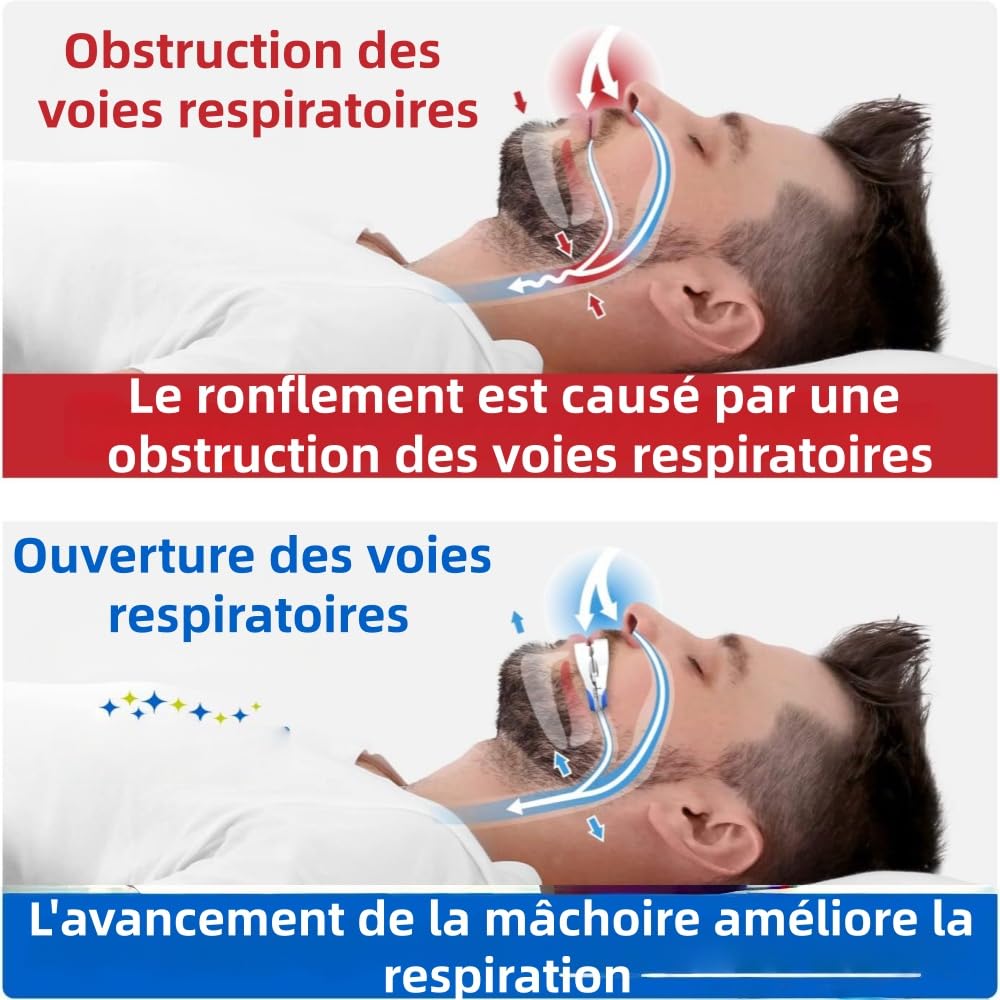 Silence dès la 1ère Nuit Dispositif anti-ronflement pour Hommes et Femmes dents améliore la respiration pendant,Compact et léger, il peut être transporté avec vous.