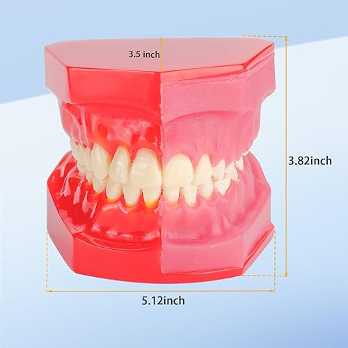 Miniatura 5 de Modelo de desarrollo de erupción dental: modelo alternativo de presión constante de dientes caducifolios claramente para mostrar el proceso de