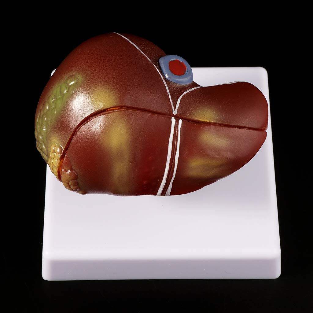 Modelo anatómico patológico del hígado humano, anatomía, escuela, enseñanza, displa