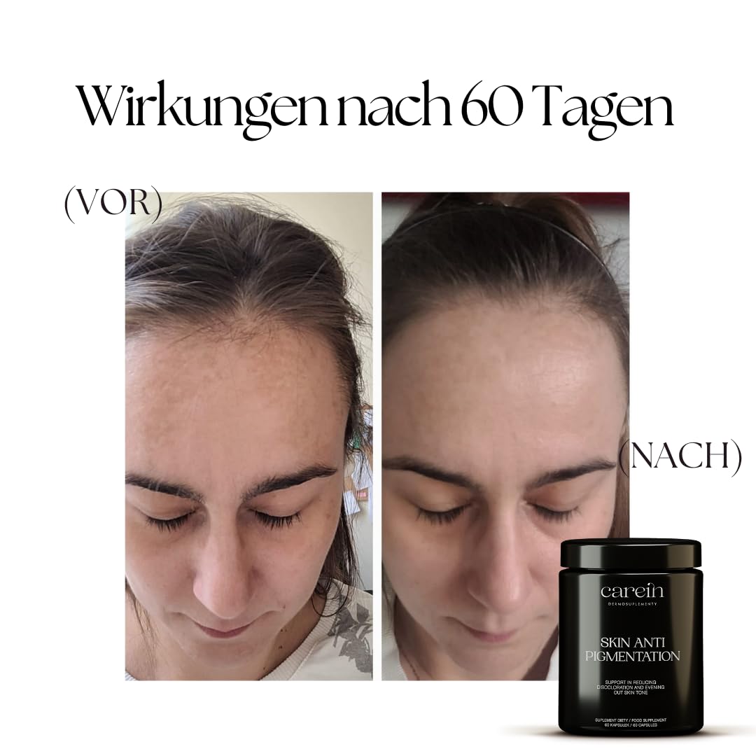 Skin Anti Pigmentation Refill - Gegen Pigmentflecken und Hyperpigmentierung - Mit Polypodium, Glutathion & Zink - 60 Vegane Kapseln - Carein