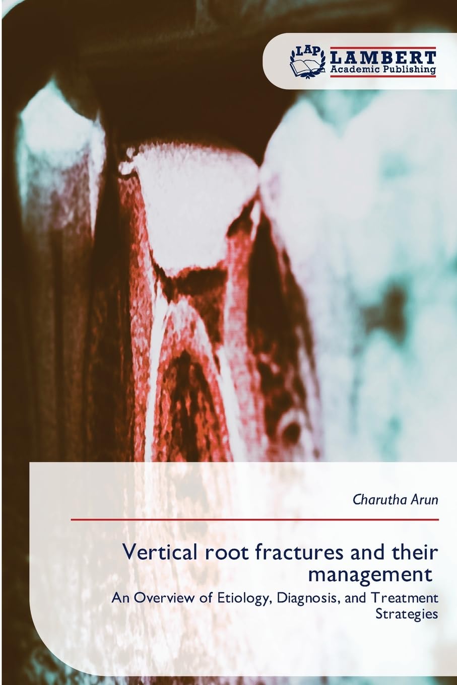 Vertical root fractures and their management: An Overview of Etiology, Diagnosis, and Treatment Strategies