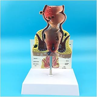 ZMX Human Anorectal Pathology Model - Medical Teaching Anorectal Acne Pathology Model - Rectal Intestinal Anatomical Model - for Teaching Study Display