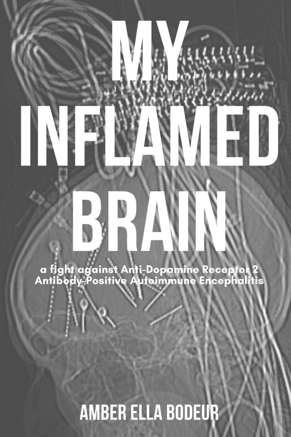 My Inflamed Brain: a fight against Anti-Dopamine Receptor 2 Antibody-Positive Autoimmune Encephalitis