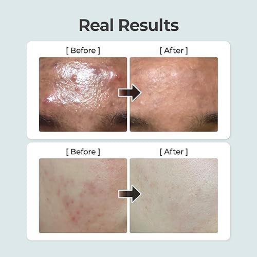 Miniatura 3 de numbuzin Tónico de hierbas calmante puro No.1  Piel propensa al acné, centella asiática, calmante profundo (10.14 onzas líquidas)