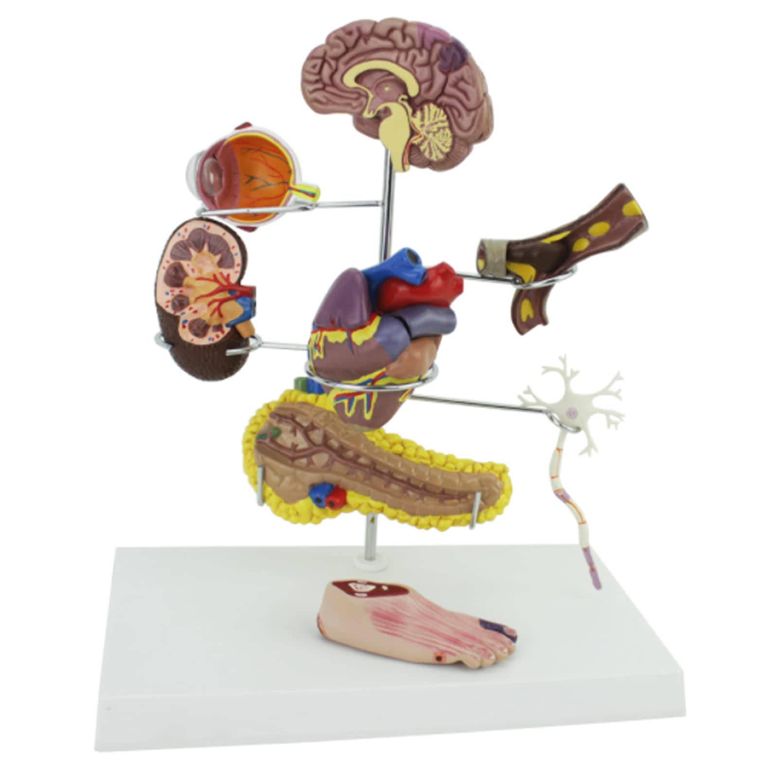 Diabetes Model Set Diabetes Anatomical Model Human Organ Model Coronary Thrombosis Arteriosclerosis Model Extracorporeal Circulation Vascular Intervention For Display Teaching Medical Model