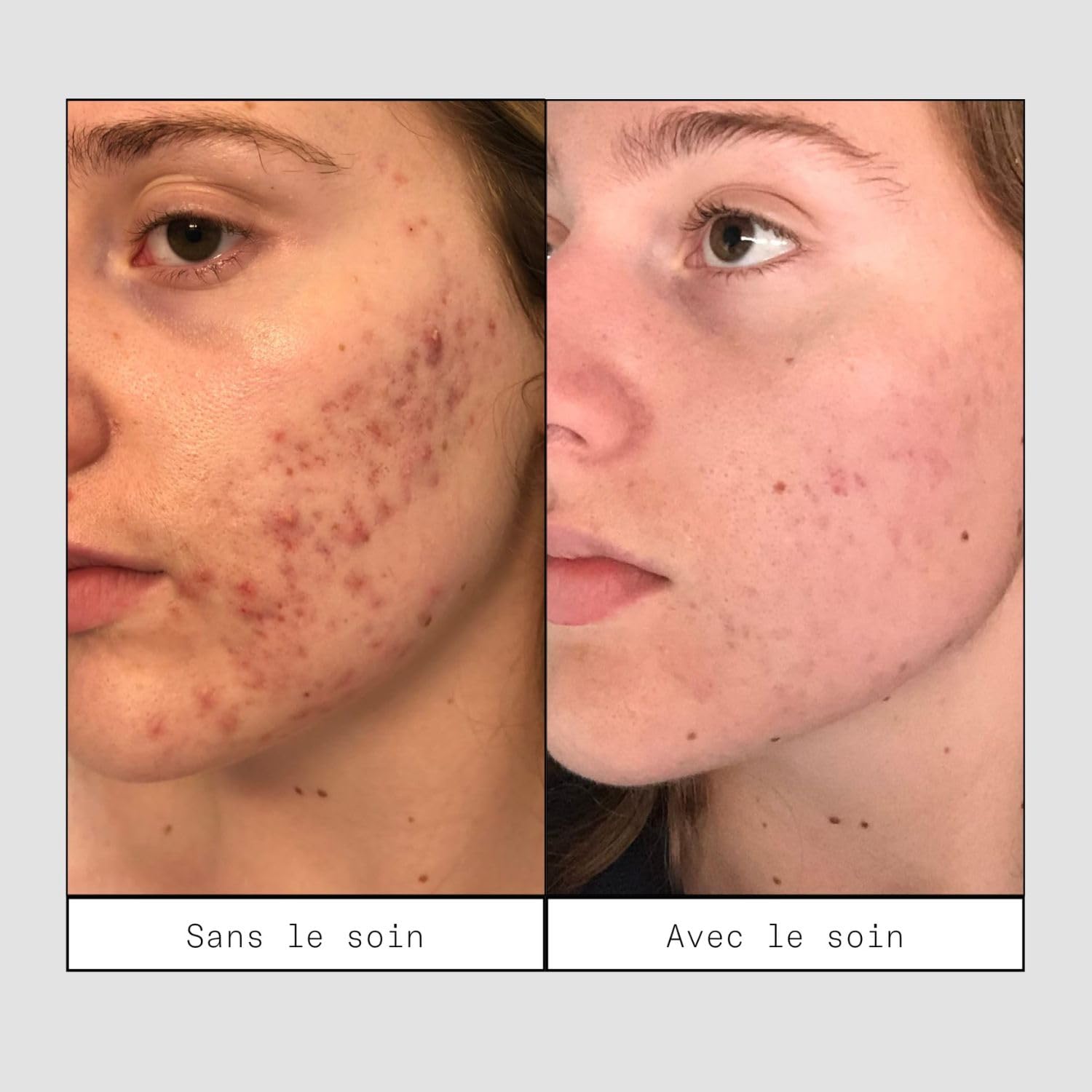 Skin & Out – Soin Boutons – 99% Naturel – Traitement ciblé stop-boutons avec Acide Salicylique 1% & Bakuchiol – Soulage les boutons, purifie et prévient l’apparition de marques post-boutons
