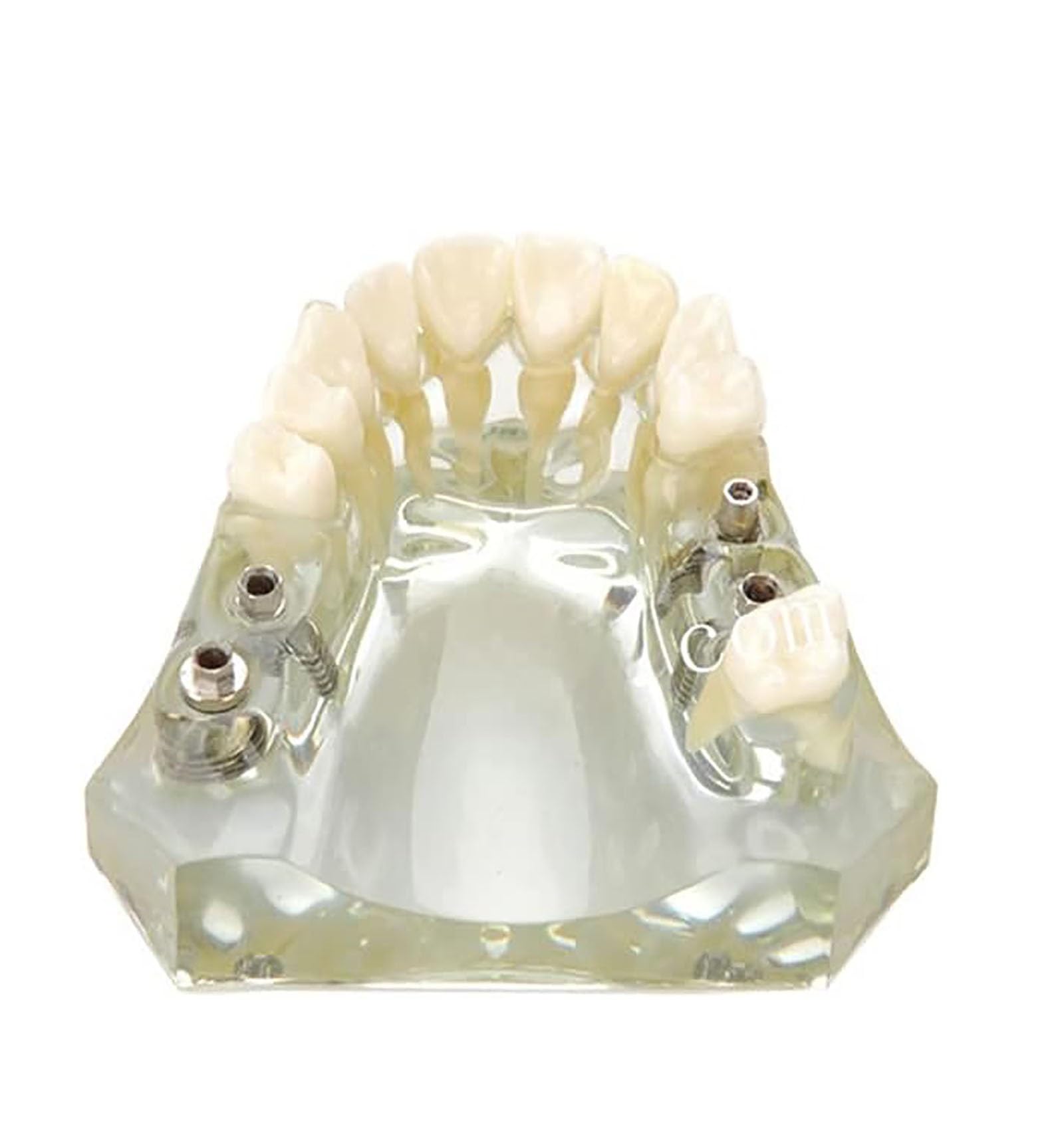 TEmkin Studienmodell, Zahnmodell, Harz-Oberkieferimplantatmodell, Transparentes Hinteres Zahnimplantat, Restaurierung, Zahnstudie, Lehrmodell, Modell für Die Zahnarztpraxis