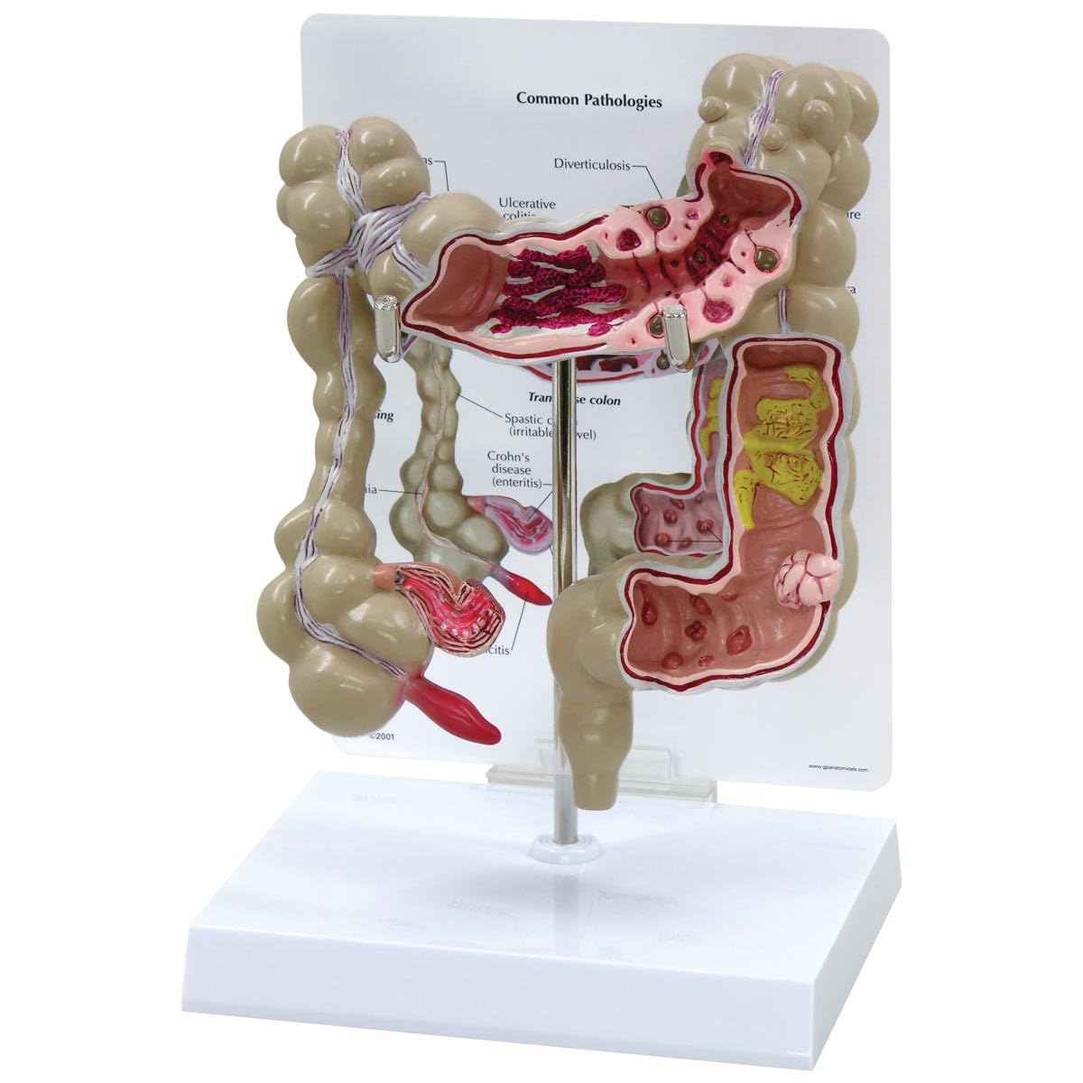 Whoolefun Human Colon Model, Large Intestine Lesion Model, 1/2 Life Size Colon Pathology Model, Digestive System Teaching Tool, Replica For Anatomy Science Education