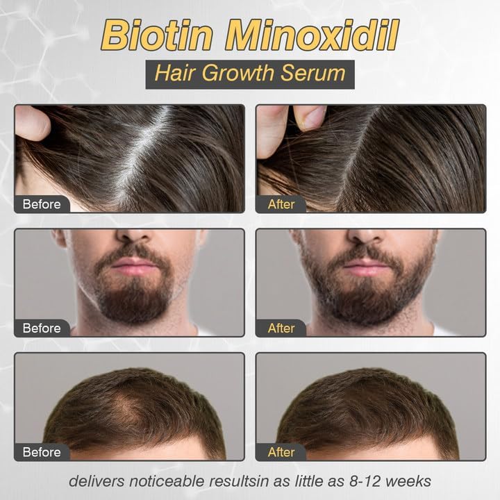 Image of 5% Minoxidil Hair Growth for Men and Women, Minoxidil Hair Growth Serum, Promotes Hair Growth, Strengthens Hair Follicles, Helps Prevent Hair Fall and Hair Loss