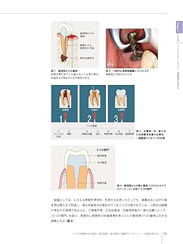 歯界展望別冊 エンド処置歯の支台築造・歯冠修復 歯内療法と補綴