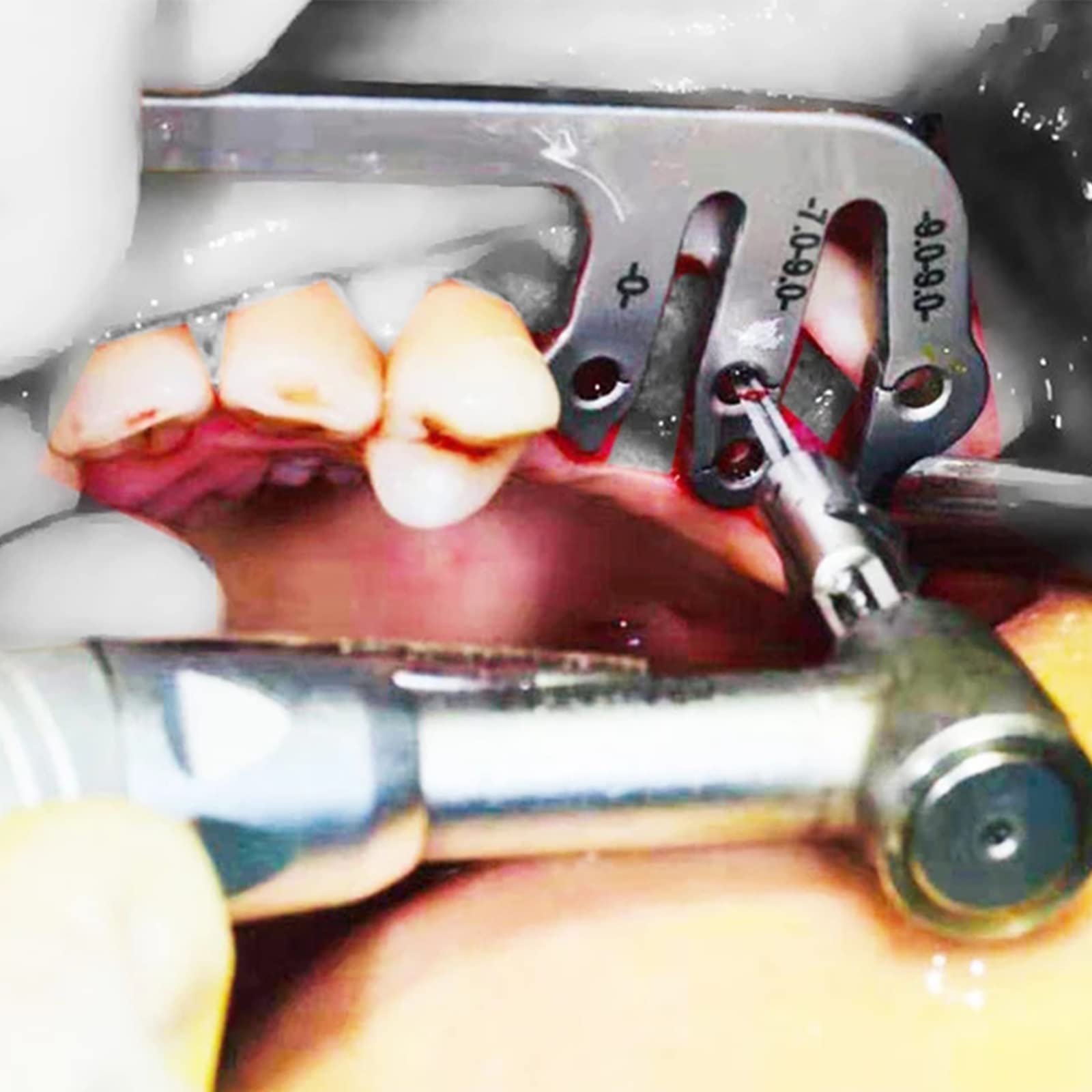 Guida All'impianto Dentale Impostare Oral Piantatura Posizionamento Guida Di Posizionamento Guida Per La Perforazione Posizionamento Del Righello Angolo Righello Strumenti Dell'impianto Dentista