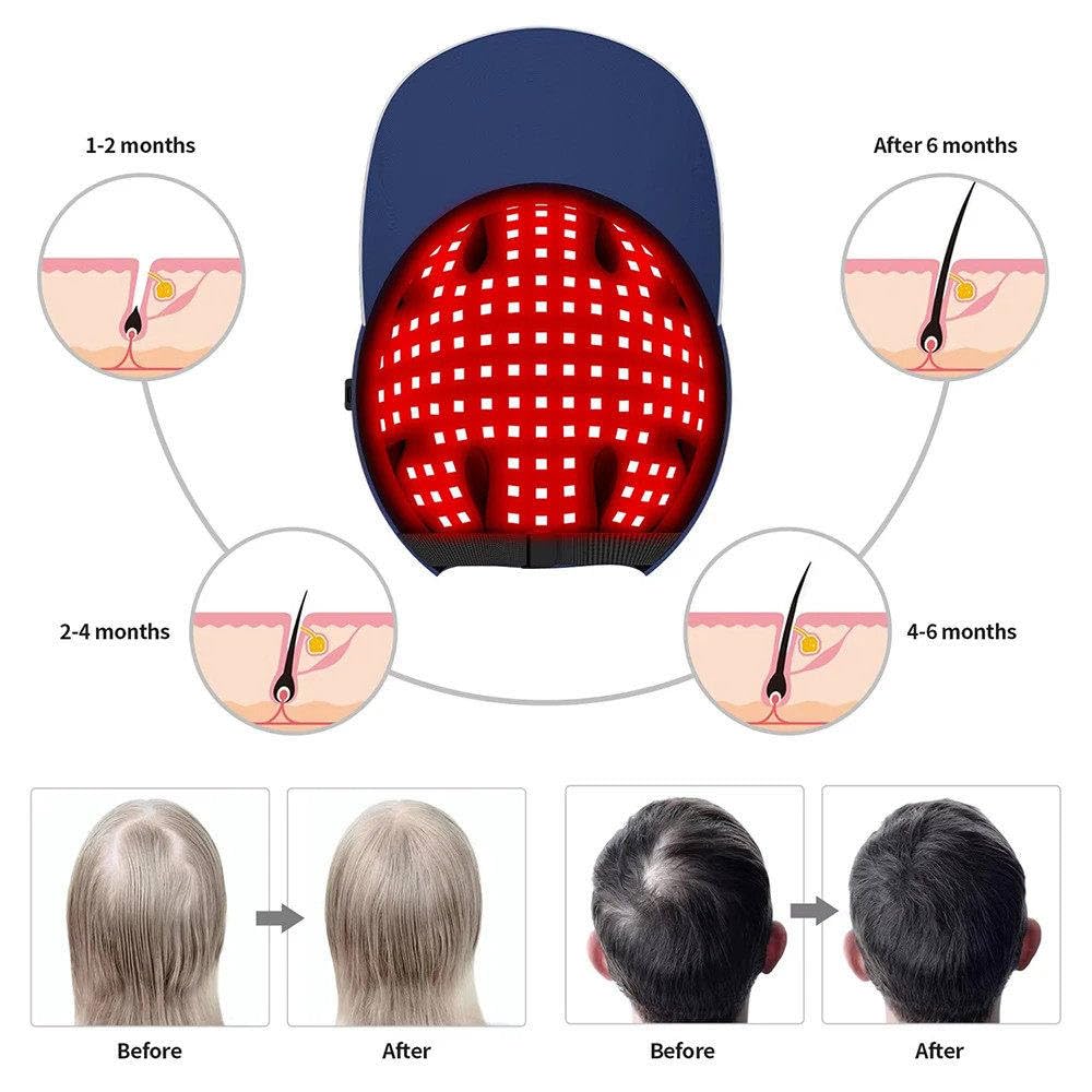 Casco per La Crescita Dei Capelli, 160 LED 660nm/850nm/940nm, Cappello a Luce Infrarossa Vicina Con Timer per Uomo E Donna, Rinforza Le Radici Dei Capelli, Cura Del Cuoio Capelluto, Allevia La Fatica