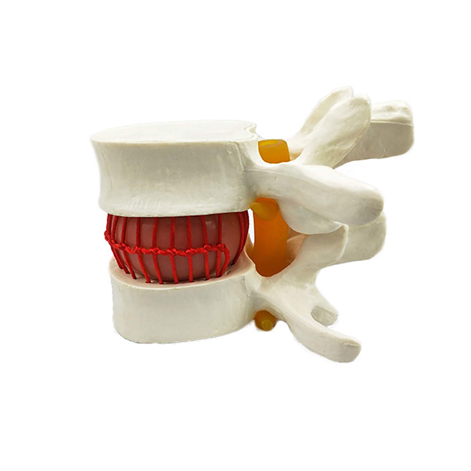 Modello Anatomico Di Ernia Del Disco Lombare, Colonna Vertebrale Umana Ingrandita 1,5x, In PVC, Per Studio Medico E Educazione Pazienti