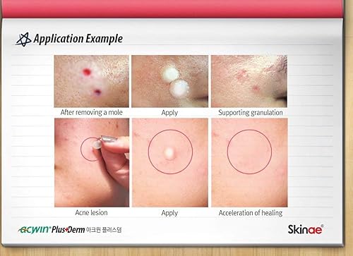 Miniatura 5 de Acwin Plus Derm - Paquete de 4 parches de cobertura absorbente de acné, apósito húmedo para heridas para problemas de piel, acné, cuidado de