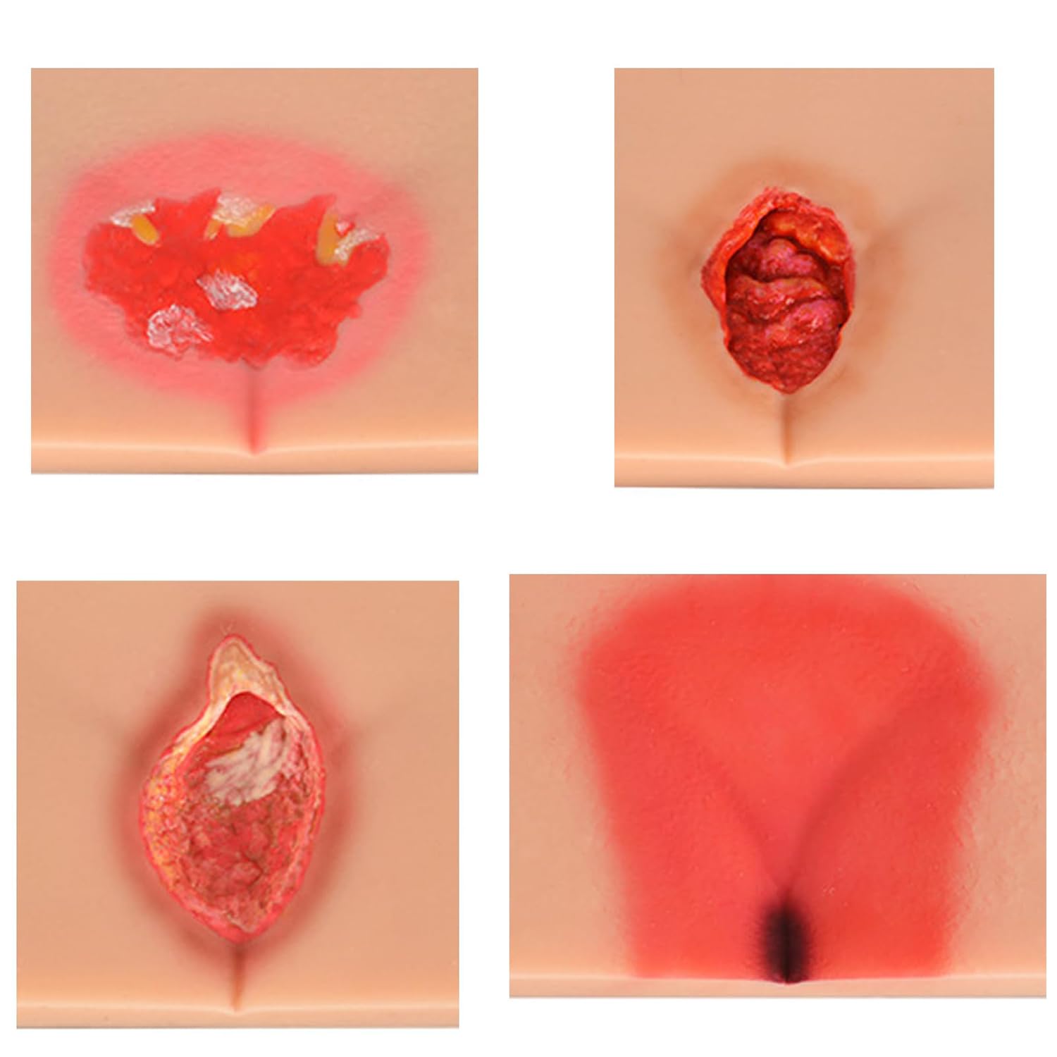 Simulatore di piaghe da decubito, modello di allenamento per ulcera da decubito, strumento dimostrativo realistico per lesioni da pressione per addestramento medico e pulizia delle ferite