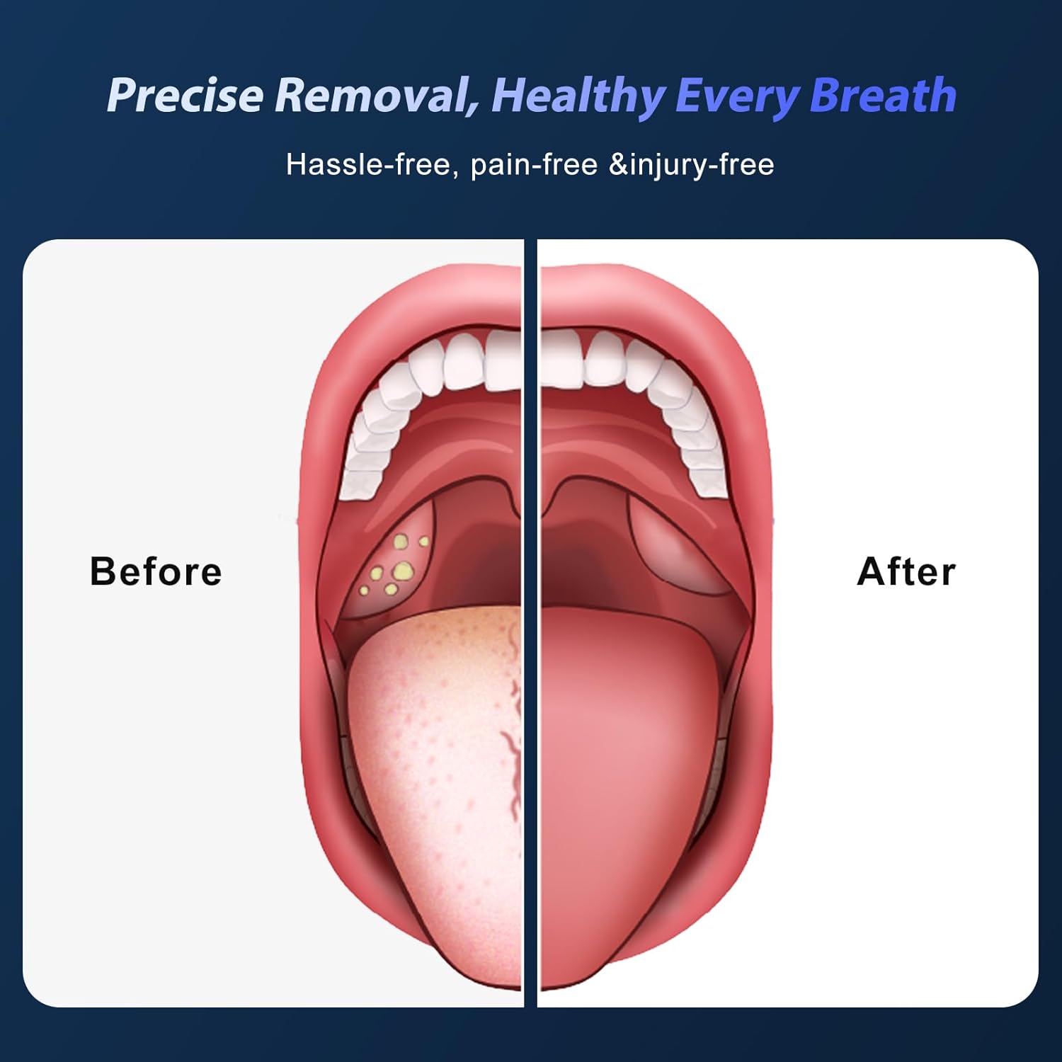 Electric Tonsil Stone Remover, 6 Suction Modes, 6-in-1 Probes & Ultra-Bright LED, Tonsil Stone Vacuum Kit with Food-Grade Silicone Tips, Painless Cleaning for Fresh Breath,Rechargeable & Waterproof