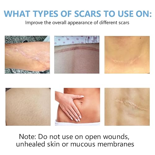 Miniatura 7 de Hojas de silicona para cicatrices de 1.6 x 120 pulgadas, cinta de silicona para eliminar cicatrices, parches para cicatrices quirúrgicas, queloides,
