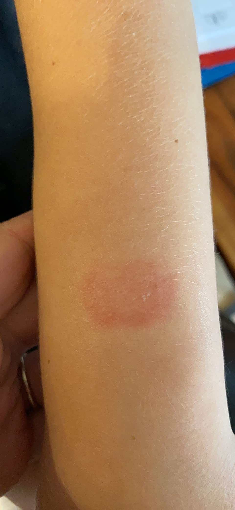 Allergische Reaktion