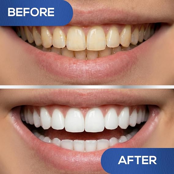 Venus Visage LED Teeth Whitening Kit with 4X 35% Carbamide Peroxide Teeth Whitening Gel Syringes, 2X Remineralization Gel Syringes, Whitener Trays, LED Whitener Device & Shade Guide
