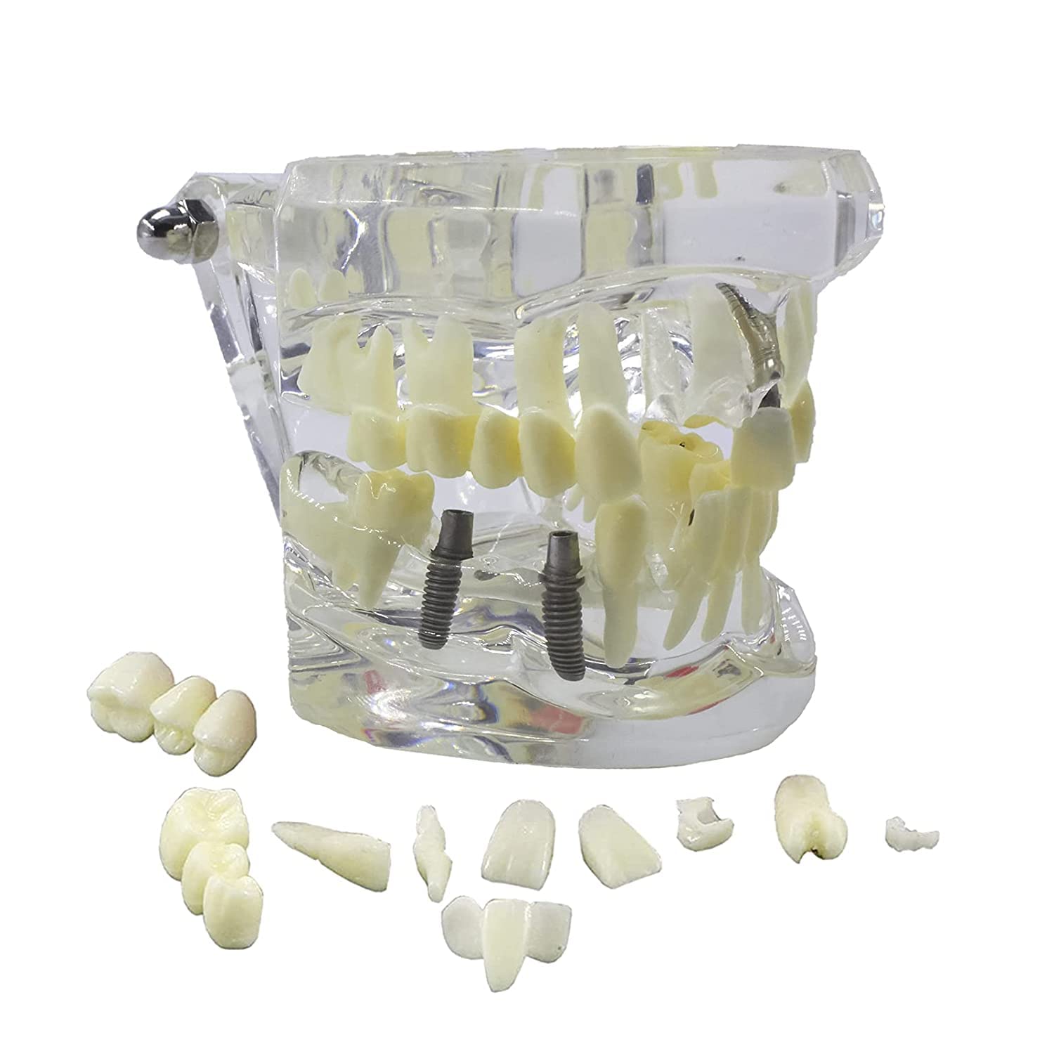 NC NC NC NC NC NC NC NC NC NC NC NC NC Teeth Model Dental Implant Restoration Model Typodont Transparent Removable Tooth Disease Pathology Teaching Learning for Dentist Dental Student (Clear)